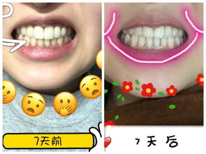 活性炭牙膏能美白牙齿吗