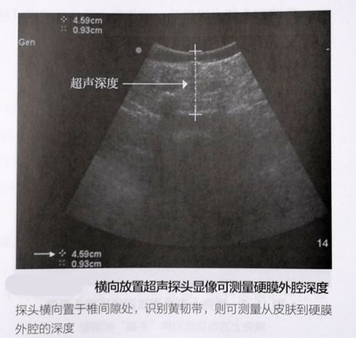 妇科外用活性炭栓塞