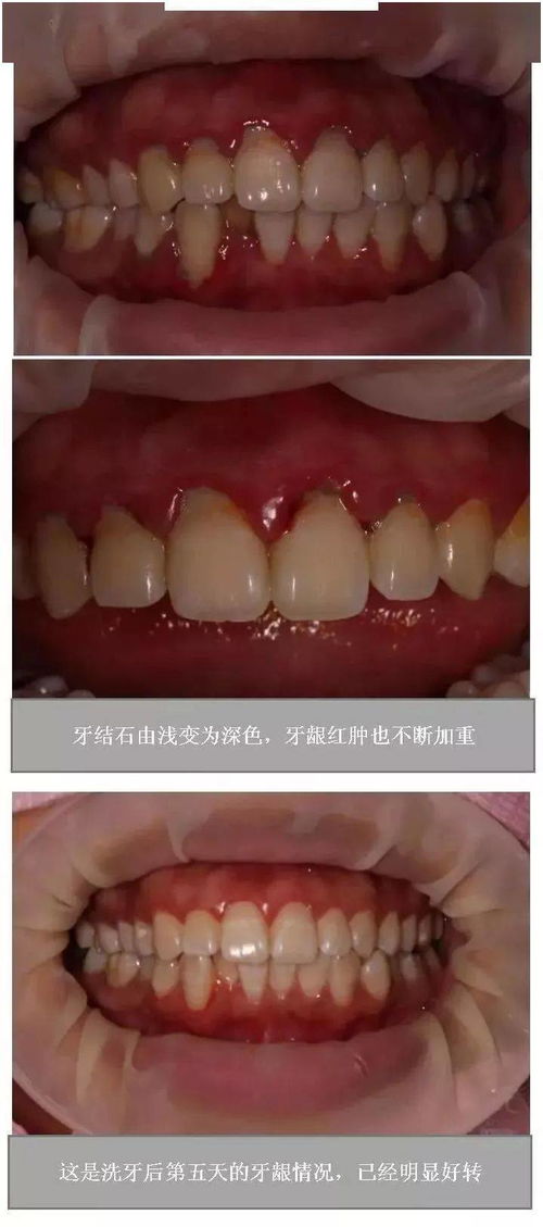 用活性炭洗牙