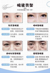 眼袋治疗用活性炭