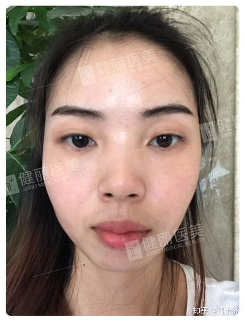 治疗眼袋用什么方法最好