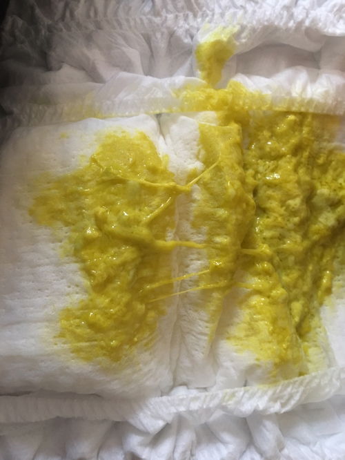 服用活性炭粪便颜色